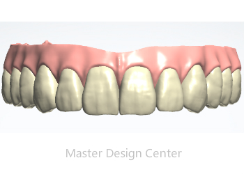 Full Arch Implant Bridge