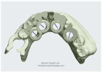 Surgery Guide Edentulos